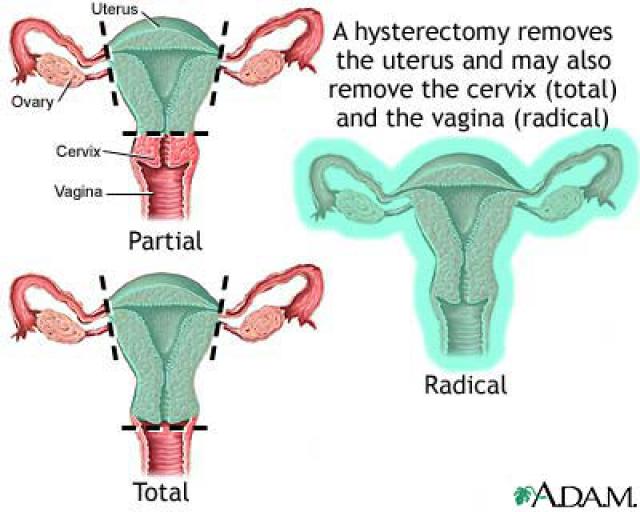 How Do They Leave Ovaries After Hysterectomy