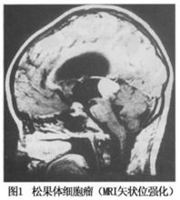 松果体细胞瘤 松果体细胞瘤